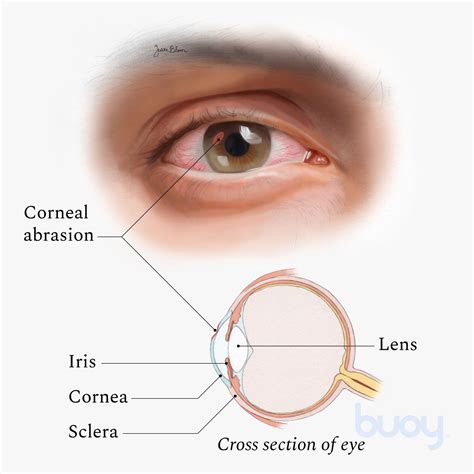 Eye Cornea Damage Symptoms - Infoupdate.org