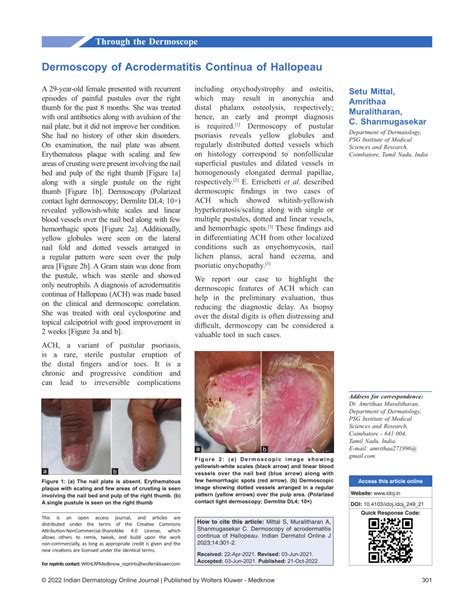 (PDF) Dermoscopy of Acrodermatitis Continua of Hallopeau