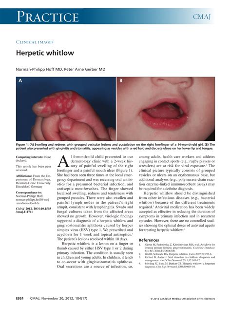 (PDF) Herpetic whitlow