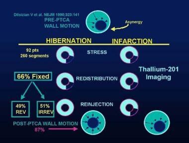 Myocardial Stunning; Stunned Myocardium; Hibernation, Myocardial; Myocardial Hibernation