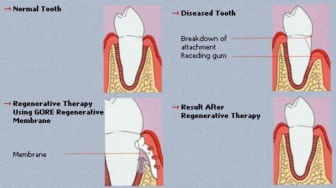 Guided Tissue Regeneration | Periodontal & Implant Associates