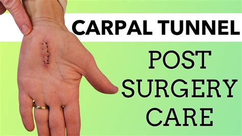 After Carpal Tunnel Surgery Exercises - Health and Fitness