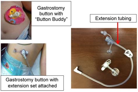 how to remove a peg tube - spencergerton