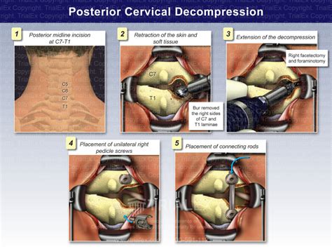 Posterior Cervical Decompression - TrialQuest Inc.