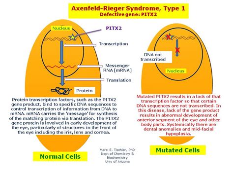 Axenfeld-Rieger Syndrome, Type 1 | Hereditary Ocular Diseases