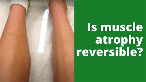 Is muscle atrophy reversible? - YouTube