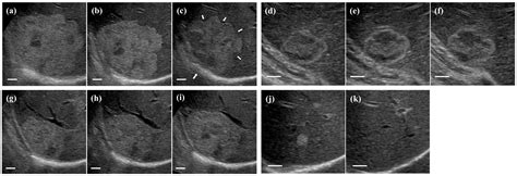 JCM | Free Full-Text | The Natural History and Management of Hepatic Hemangioma