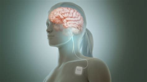 Vagus Nerve Stimulation For Anxiety: Is It The Right Option?