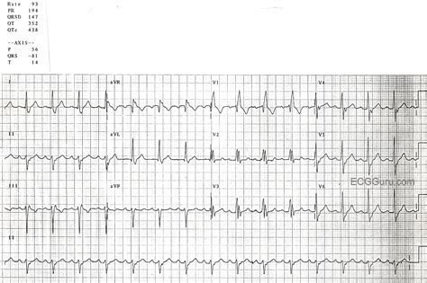 Right Bundle Branch Block With Left Anterior Fascicular Block | ECG Guru - Instructor Resources