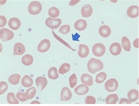 Sickle Cells • The Blood Project