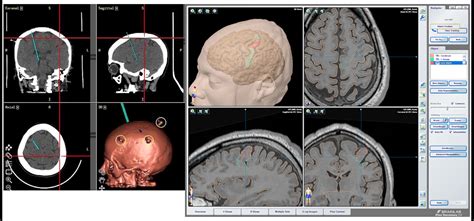 Cureus | The Accuracy of Topographical Methods in Determining Central ...