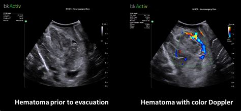 Real-Time Active Imaging with Intraoperative Ultrasound for Hematoma ...