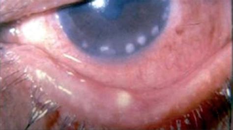 Corneal Staph Infection