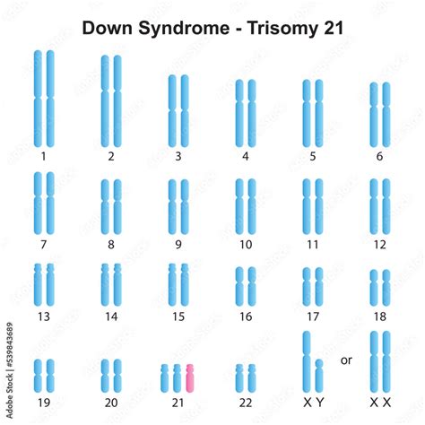 Scientific Designing of Down Syndrome (Trisomy 21) Karyotype. Colorful Symbols. Vector ...