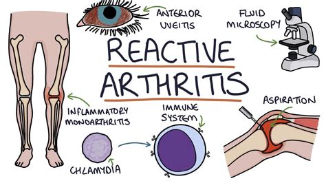 Understanding Reactive Arthritis - YouTube