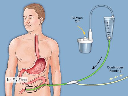 What is Jejunostomy? - Ostomy Tips | Nursing education, Nursing students, Nurse