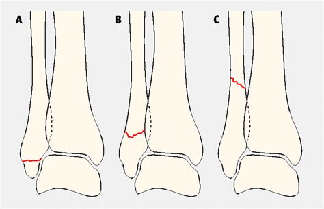 Management of ankle fractures | The BMJ