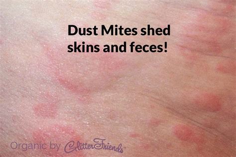 Dust Mites | Bed bug bites pictures, Bed bug bites, Bed bugs