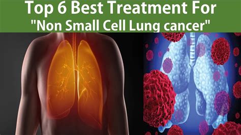 Top 6 Best "Non Small Cell Lung cancer" Treatment 😱 | Treatments are ...