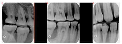 Prevent Technique Errors - Dimensions of Dental Hygiene