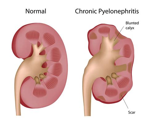 Pyelonephritis - Net Health Book