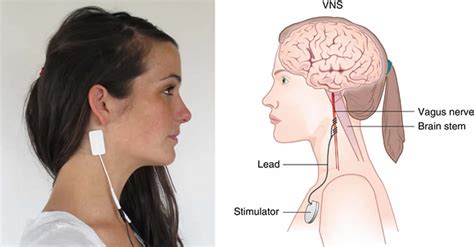 Vagus nerve stimulation, vagus nerve stimulation therapy, uses & side effects