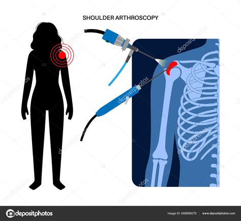 Shoulder Arthroscopy Procedure Rotator Cuff Tears Shoulder Impingement ...