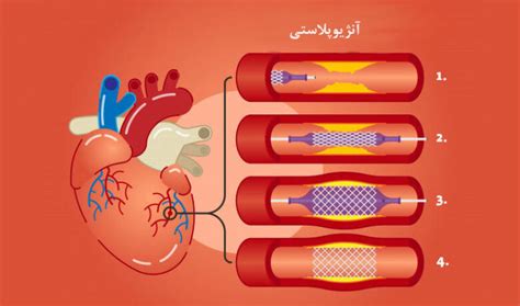 تحقیق درباره آنژیو پلاستی - انشا باز