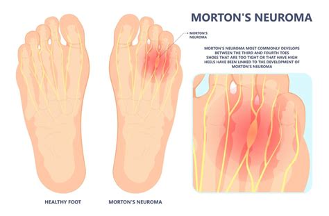 Interdigital Neuroma (Morton's Neuroma) - Physioflow PT | Physical Therapy | Vancouver, WA