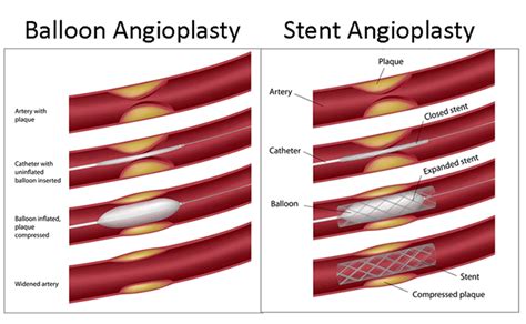 Balloon and Stent Angioplasty Diagrams and a short illustrated video of Stent Angioplasty. | May ...