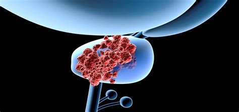 Abiraterone + ADT: A New Standard of Care for Metastatic HSPC — prIME