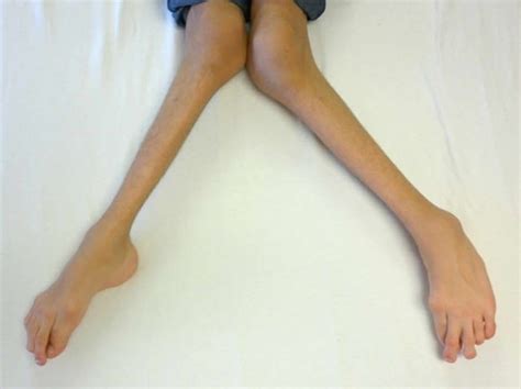 Morquio syndrome causes, symptoms, diagnosis, life expectancy & treatment