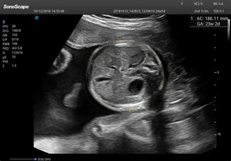 Obstetric Ultrasound: Purpose and Procedure | Healthtian