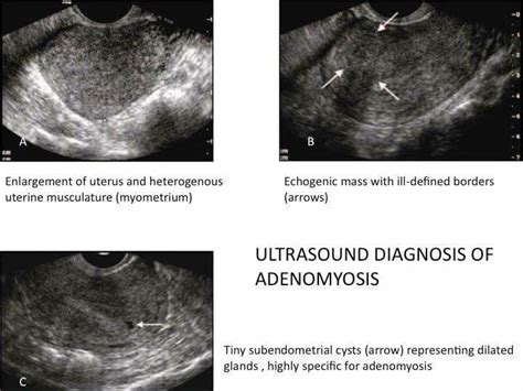 Adenomyosis | Sonography, Ultrasound diagnosis, Ultrasound