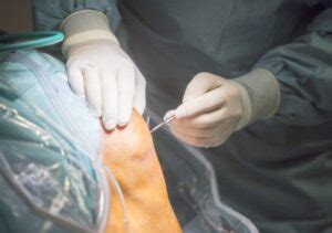 Patellar Tendon Surgery In 2024 - Dr. Pamela Mehta, San Jose