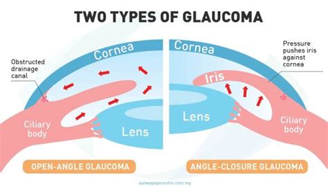 The Two Types of Glaucoma: Primary Open Angle Glaucoma & Primary Angle ...