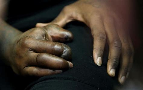 Picture Of NY Giants Jason Pierre-Paul's Hand After He Blew Off Two Fingers & His Thumb In ...