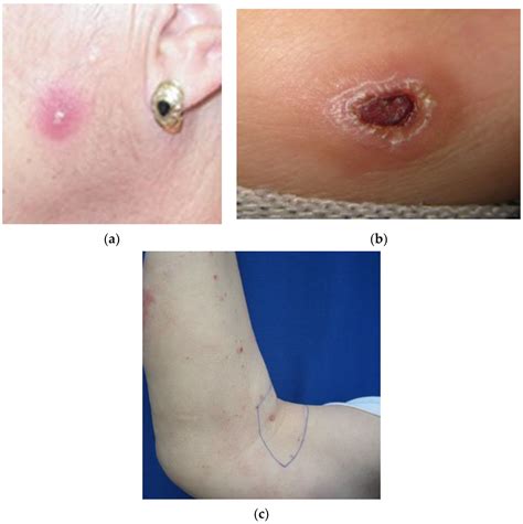 Microorganisms | Free Full-Text | Underestimation of Human Cutaneous Leishmaniasis Caused by ...