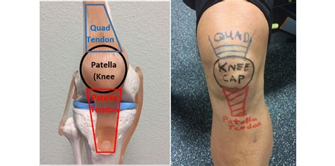 Patella Tendonitis | Advanced Orthopaedic Specialists | Fayetteville, AR | Rogers, AR