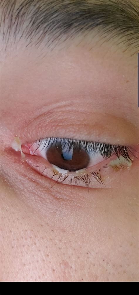 A bit of sleep in my eye : r/mildlydisgusting