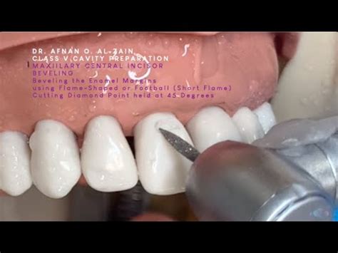 Class V cavity preparation for composite on a maxillary central incisor (#11) - Arabic عربي ...