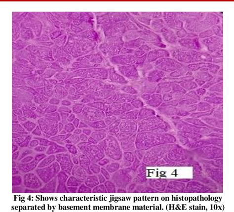 Figure 4 from Cytological Diagnosis of Cylindroma Scalp- A Rare Case ...