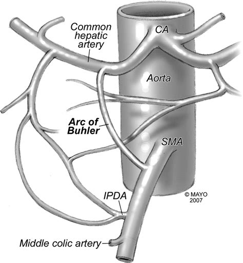 Celiac Artery Stenosis: An Underappreciated and Unpleasant Surprise in Patients Undergoing ...