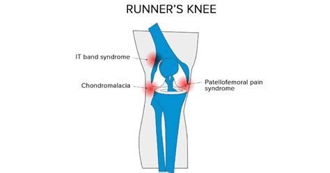 What is Runner’s Knee? (Causes, Symptoms, and Treatment)