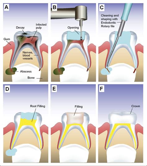 Root Canal Treatment for child | Pediatric Dentistry in Chennai