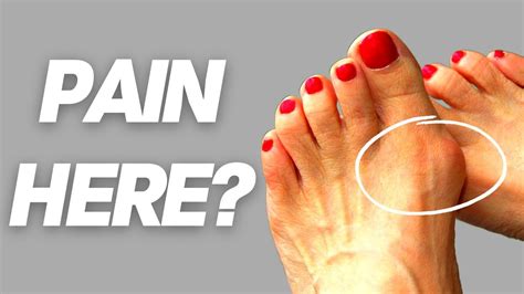 How To Shrink Bunions Naturally: Treatment Without Surgery