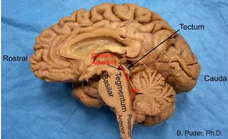 OPT 113 Brainstem Flashcards | Quizlet