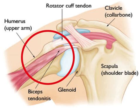 Biceps Tendonitis: Causes,Symptoms,Diagnosis & Treatment » How To Relief