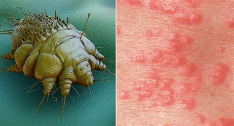 Scabies - Symptoms, Diagnosis, prevention and Treatment of Scabies ...