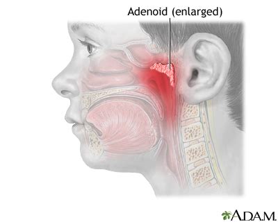 Adenoid removal - series—Indications: MedlinePlus Medical Encyclopedia